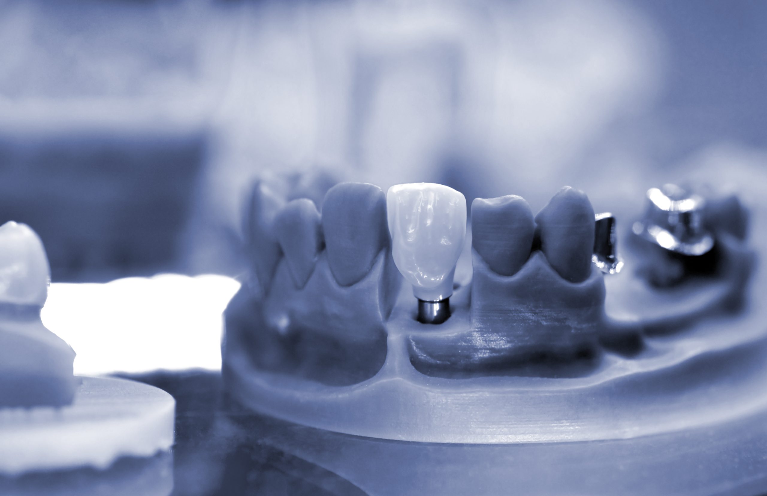 ESSE-EFFE-DENTAL-LINE-Laboratorio-Odontotecnico-Sbuttoni-Fausto-castelsangiovanni-protesi-mobile-protesi-fissa-zirconio-co-cr-disilicato-laser-melting-fresaggio-cad-cam ESSE-EFFE-DENTAL-LINE-Laboratorio-Odontotecnico-Sbuttoni-Fausto-castelsangiovanni-protesi-mobile-protesi-fissa-zirconio-co-cr-disilicato-laser-melting-fresaggio-cad-cam